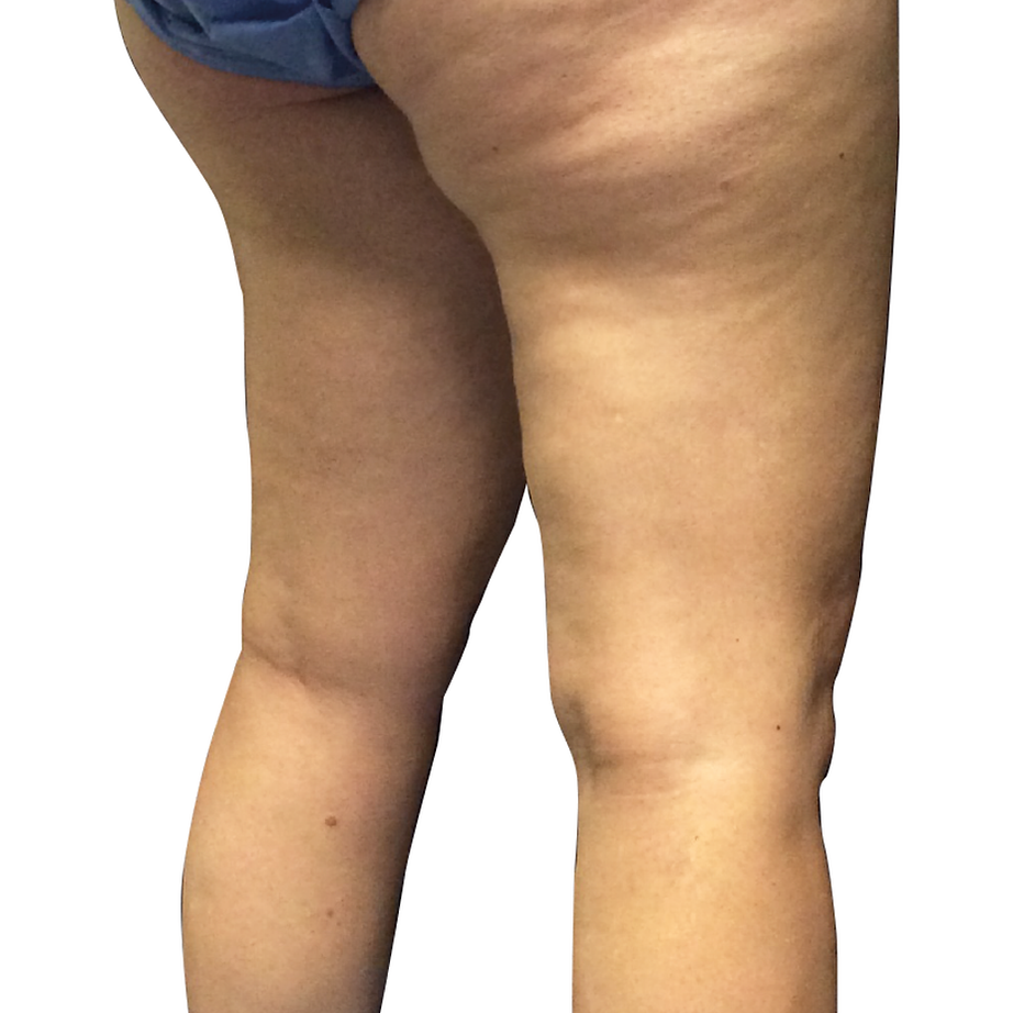 CELULITIS antes